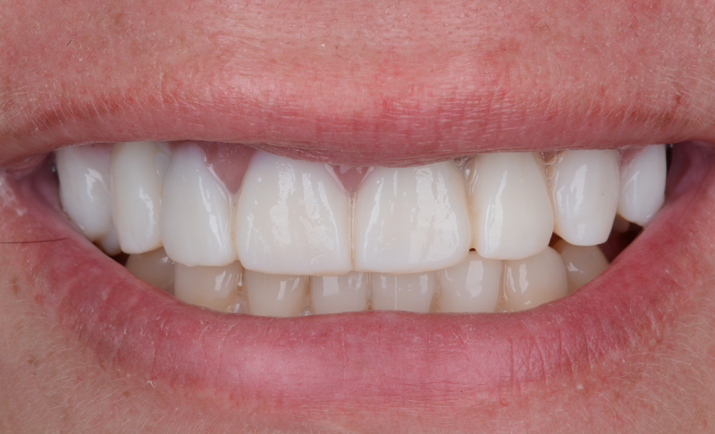 Smile Makeover &ndash; Crowns and Veneers