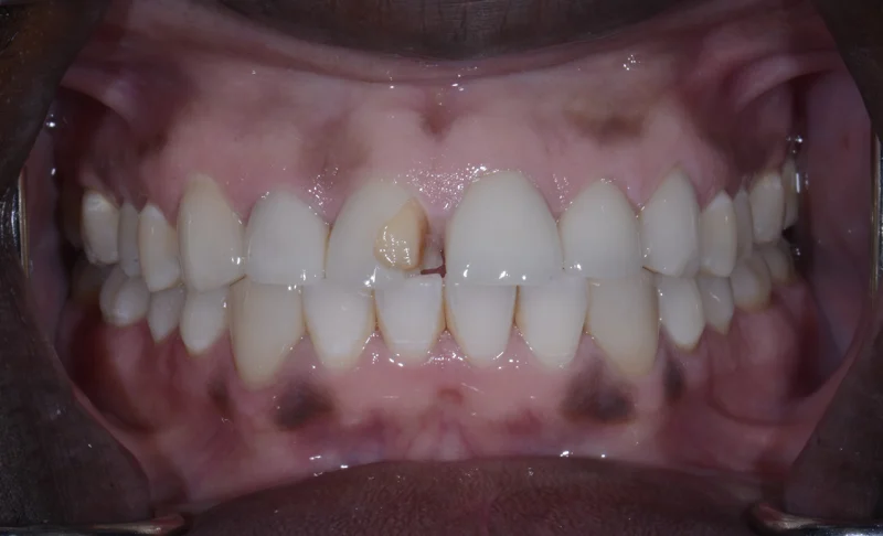 Smile Makeover &ndash; Crowns