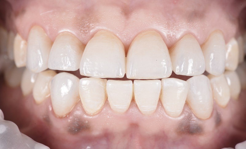 Smile Makeover &ndash; Crowns