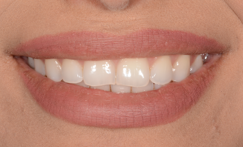 Teeth Whitening and Two Veneers