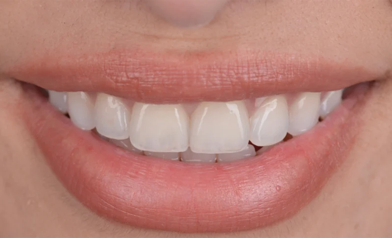Teeth Whitening and Two Veneers