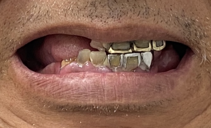 Smile Gallery in Sugar Land, TX | Prostho Dental