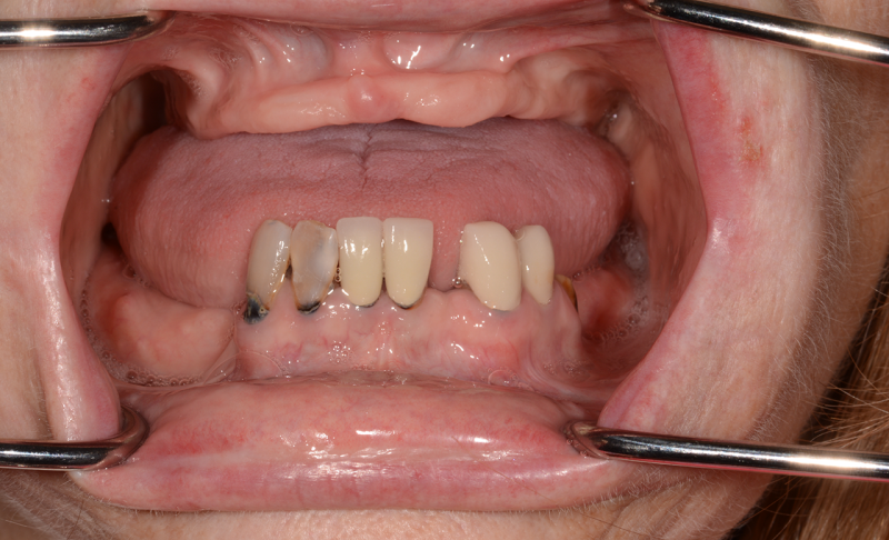 Smile Gallery in Sugar Land, TX | Prostho Dental