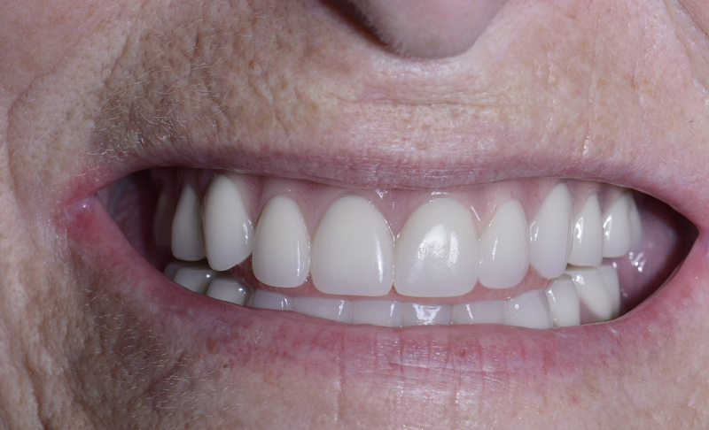 Smile Gallery in Sugar Land, TX | Prostho Dental