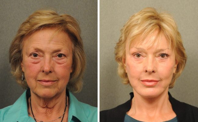 real before and after