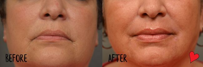 Plastic Surgery Recovery A Patient S Journey In Pictures