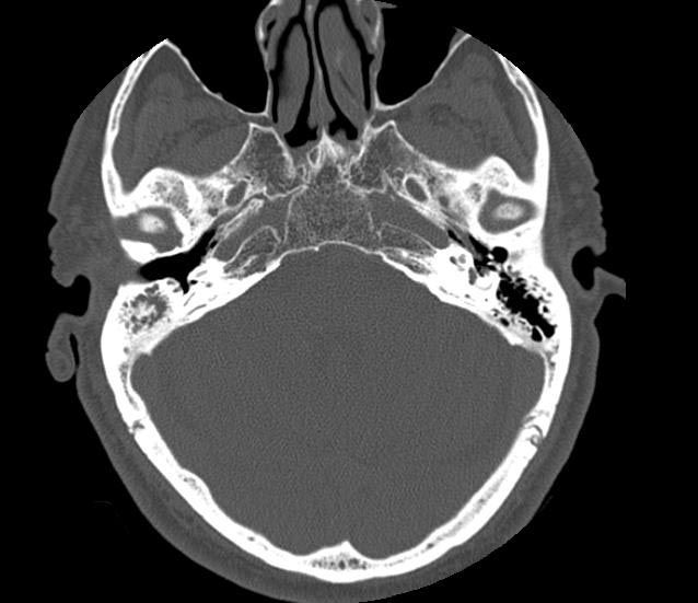 Холестеатома мрт картина