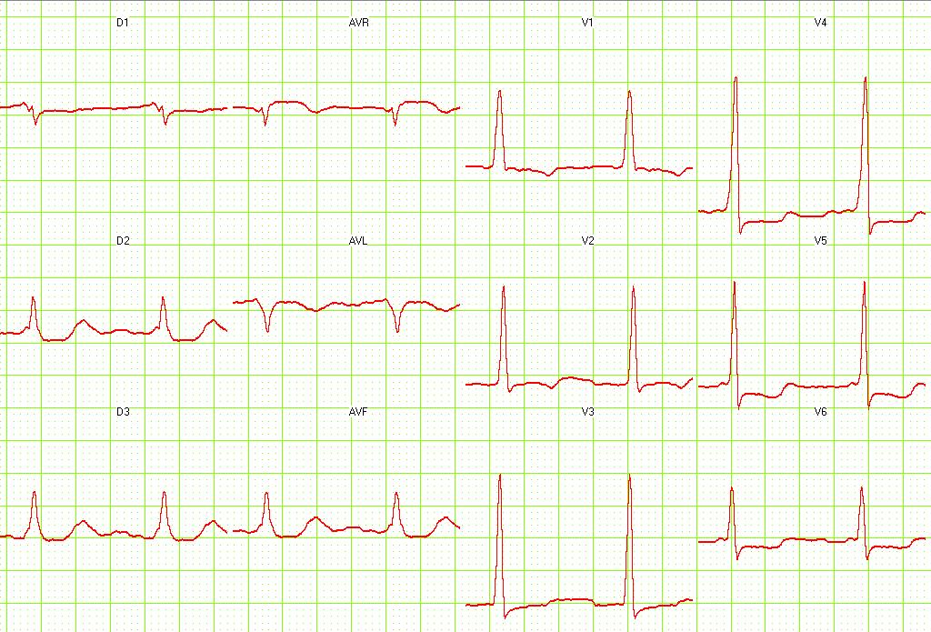 Wpw тип а. Работы по впв. Синдром вольфа-паркинсона-уайта на экг. Феномен предвозбуждения желудочков wpw. Синусовая тахикардия на экг.