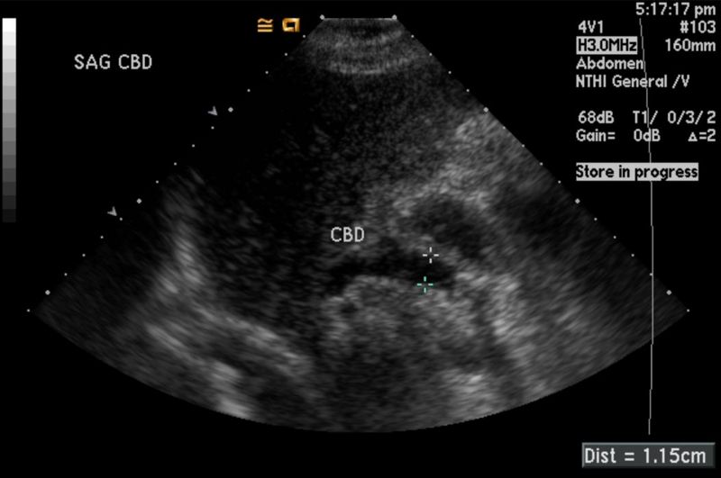 hepatobiliary ultrasound