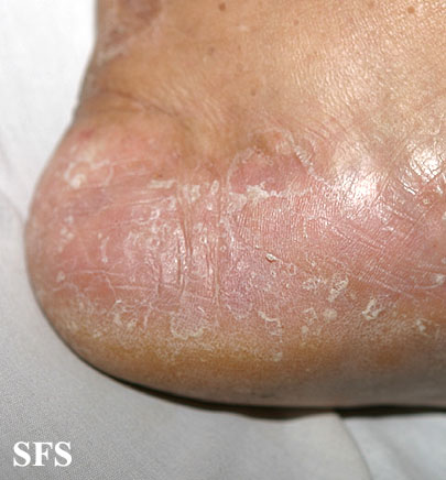 Can athletes foot cause smelly shoes? No, but athlete's foot can be a symptom of poor foot hygiene, which contributes to shoe odor. This photo shows scaly skin on a heel, a mild case of athlete's foot fungus.