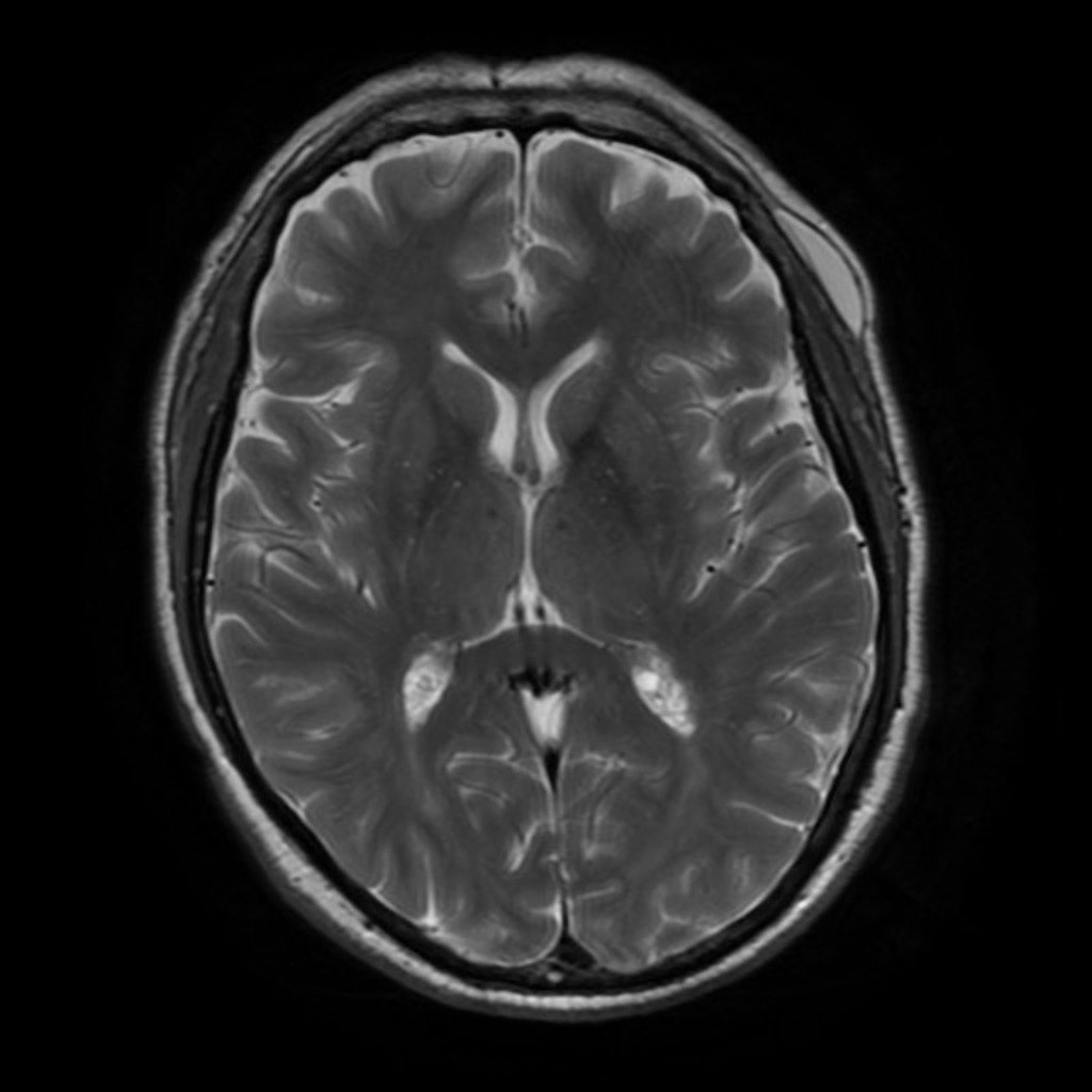 Ликворография головного мозга магнитно-резонансная. Аномалии головного мозга на мрт. Мрт головного мозга у детей норма. Мрт магнитно-резонансная томография головного мозга. Мрт снимок головы норма.