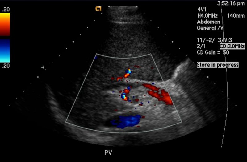 hepatobiliary ultrasound