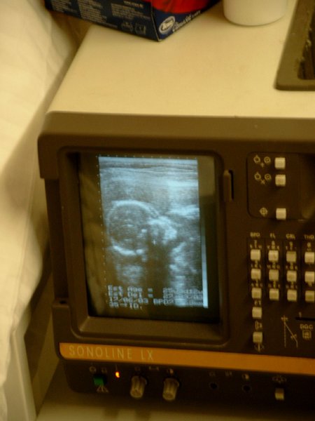 obstetrical ultrasound