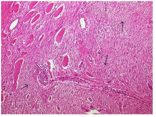 десмоидная фиброма. десмоидный фиброматоз. экстраабдоминальный десмоид.