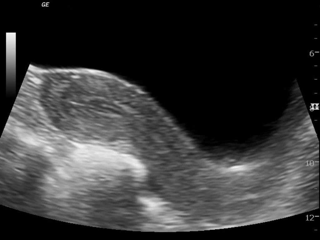 breast ultrasound