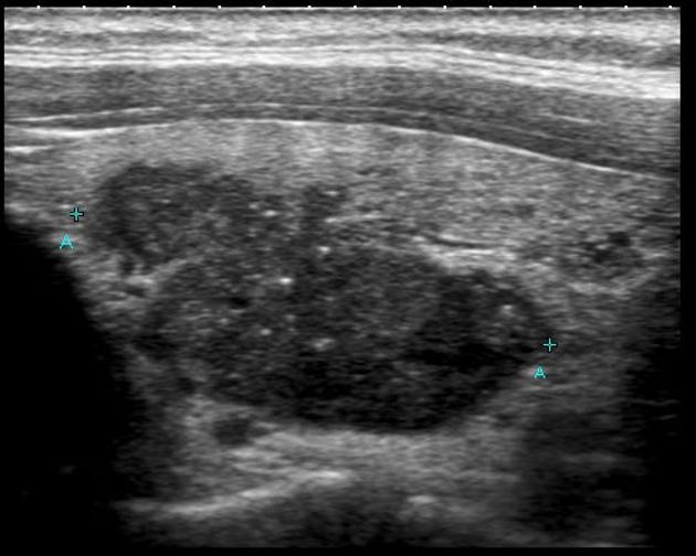 hepatobiliary ultrasound