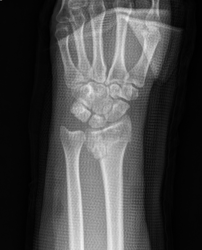 Radius fracture. Radius fracture