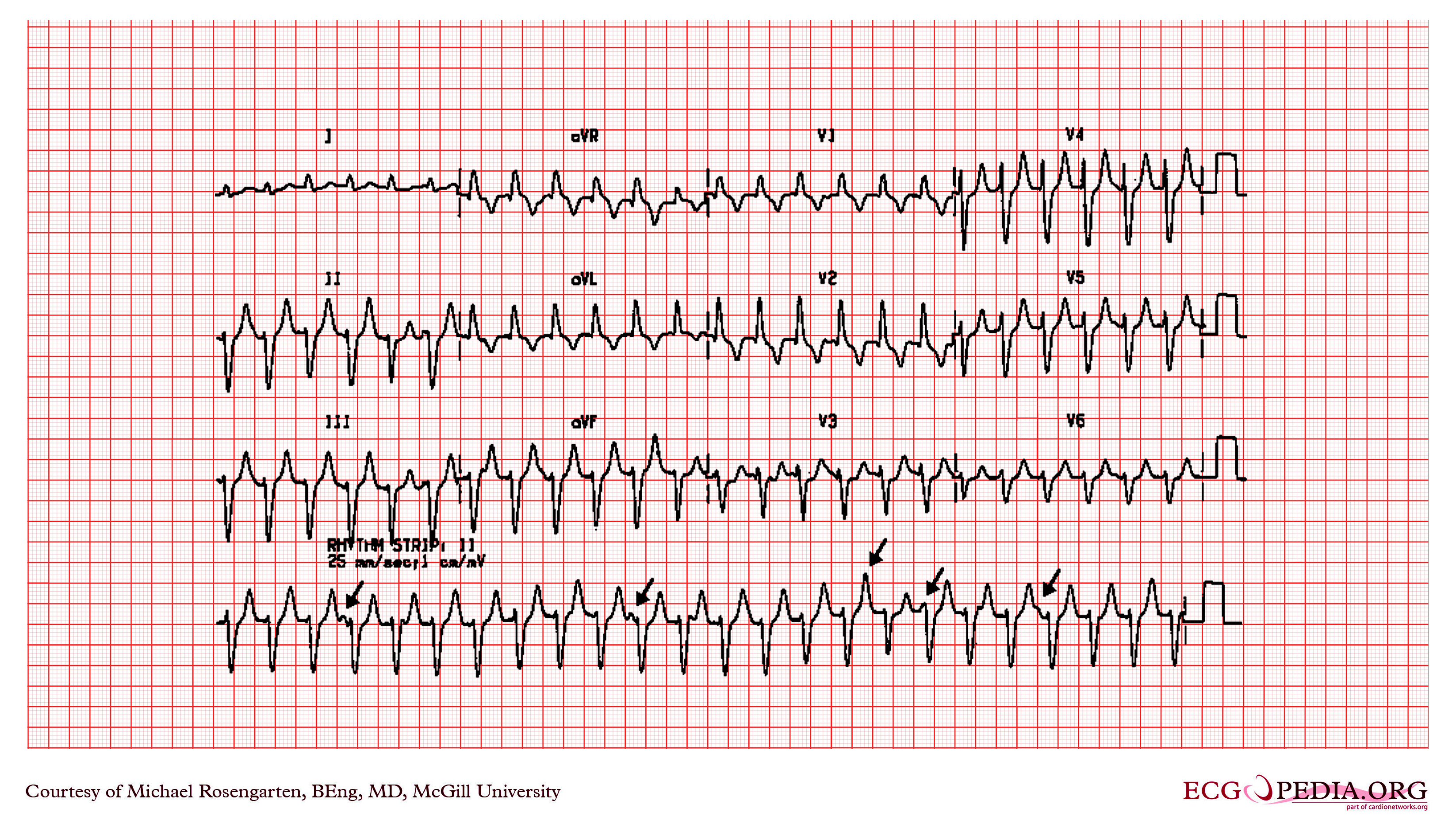 экг при синдроме вольфа-паркинсона-уайта wpw. синдром вайта.