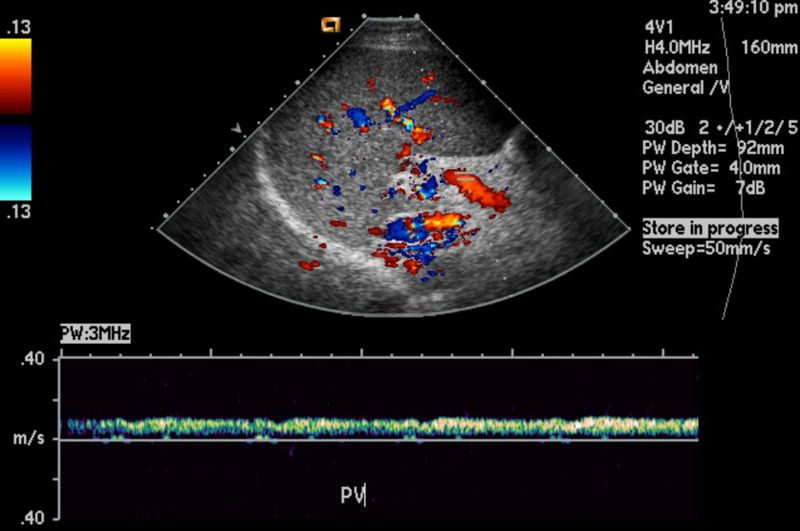 hepatobiliary ultrasound