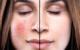 The Challenge of Coping With Rosacea