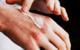 7 Tips for Alleviating Eczema