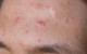 Adult Acne Causes and Treatments