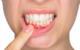 Possible Link: Gum Disease and Stroke