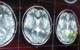 Possible Link: Gum Disease and Stroke