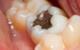 Mercury Filling Removal: A Guide