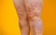 Psoriatic Arthritis: What Is It and How to Cope