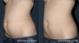 Lipolysis  Treatment in Dubai