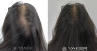 YAKER Hair Restoration +  Med Spa