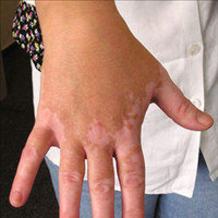 vitiligoinusa