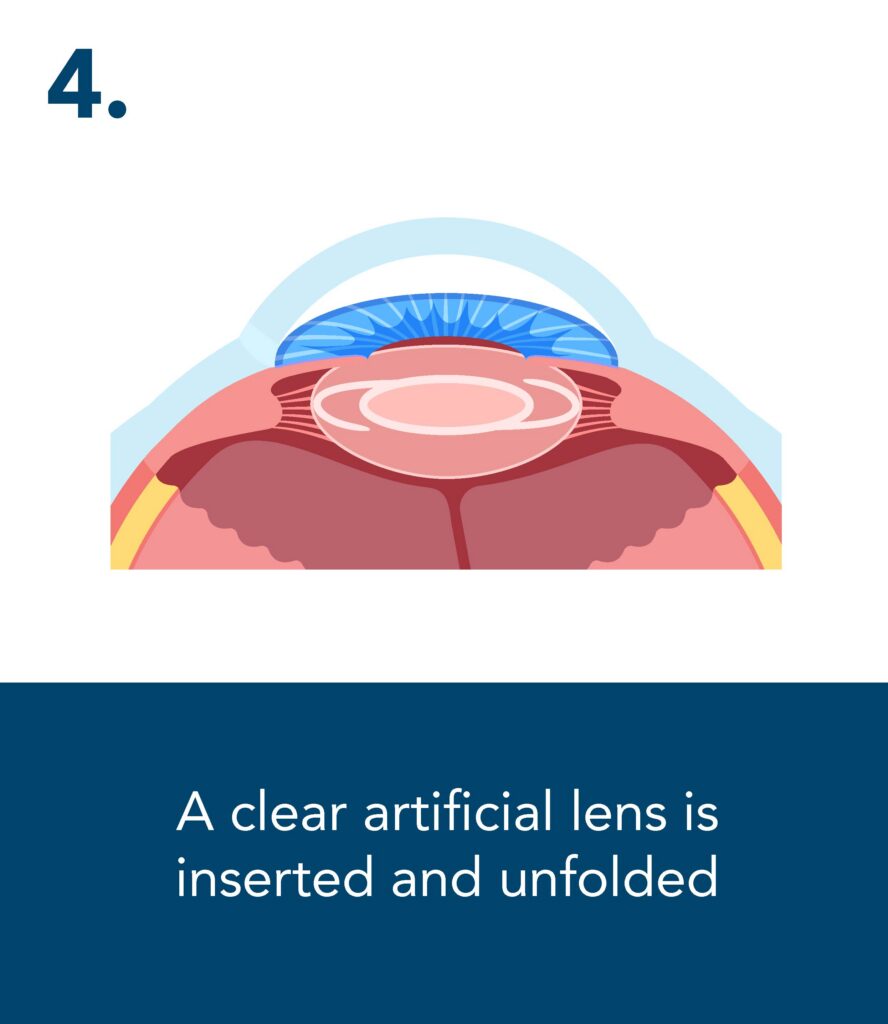 A diagram of an eye with an artificial lens. "A clear artificial lens is inserted and unfolded"