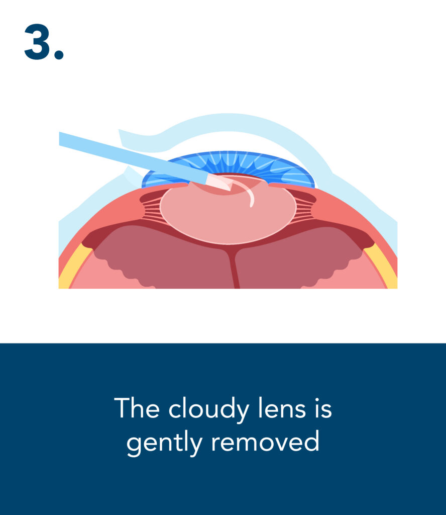 A diagram of an eye with a surgical instrument removing a cloudy lens. "The cloudy lens is gently removed"