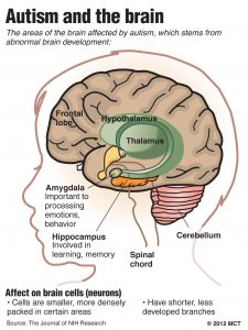 autism stem cell therapy
