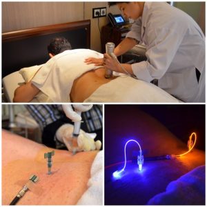 spinal cord injury treatment stem cells