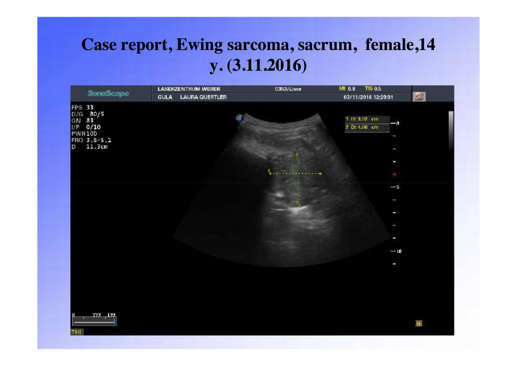pancreatic pdt cancer treatment, pdt cancer treatment, photodynamic cancer treatment, alternative cancer treatment,