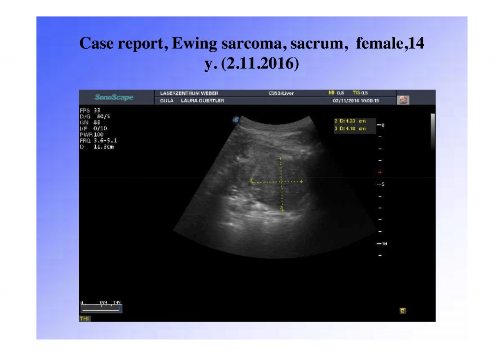 pancreatic pdt cancer treatment, pdt cancer treatment, photodynamic cancer treatment, alternative cancer treatment,