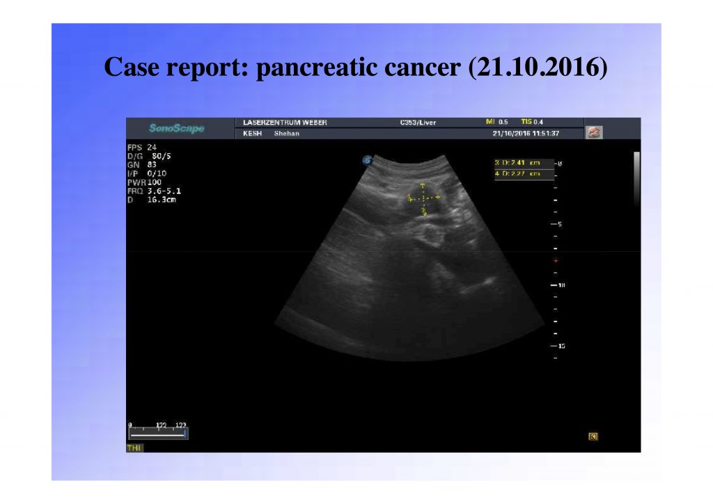 pancreatic pdt cancer treatment, pdt cancer treatment, photodynamic cancer treatment, alternative cancer treatment,