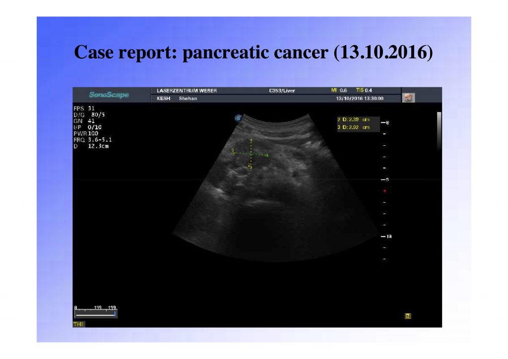 pancreatic pdt cancer treatment, pdt cancer treatment, photodynamic cancer treatment, alternative cancer treatment, pancreatic cancer treatment,