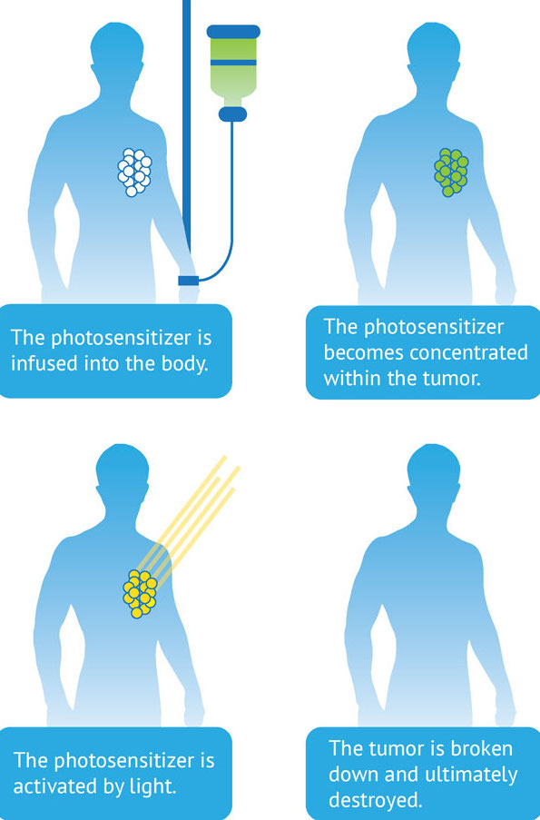 pdt cancer treatment