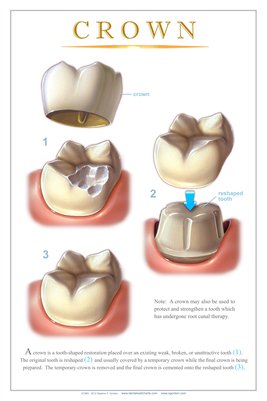 "CROWN" - (white) Dental Wall Chart DWC112