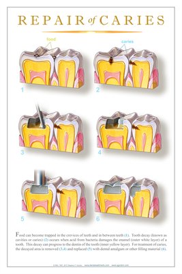 "REPAIR OF CARIES" #3 - (white) Dental Wall Chart DWC506