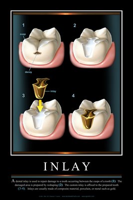 "INLAY" - (black) Dental Wall Chart DWC801