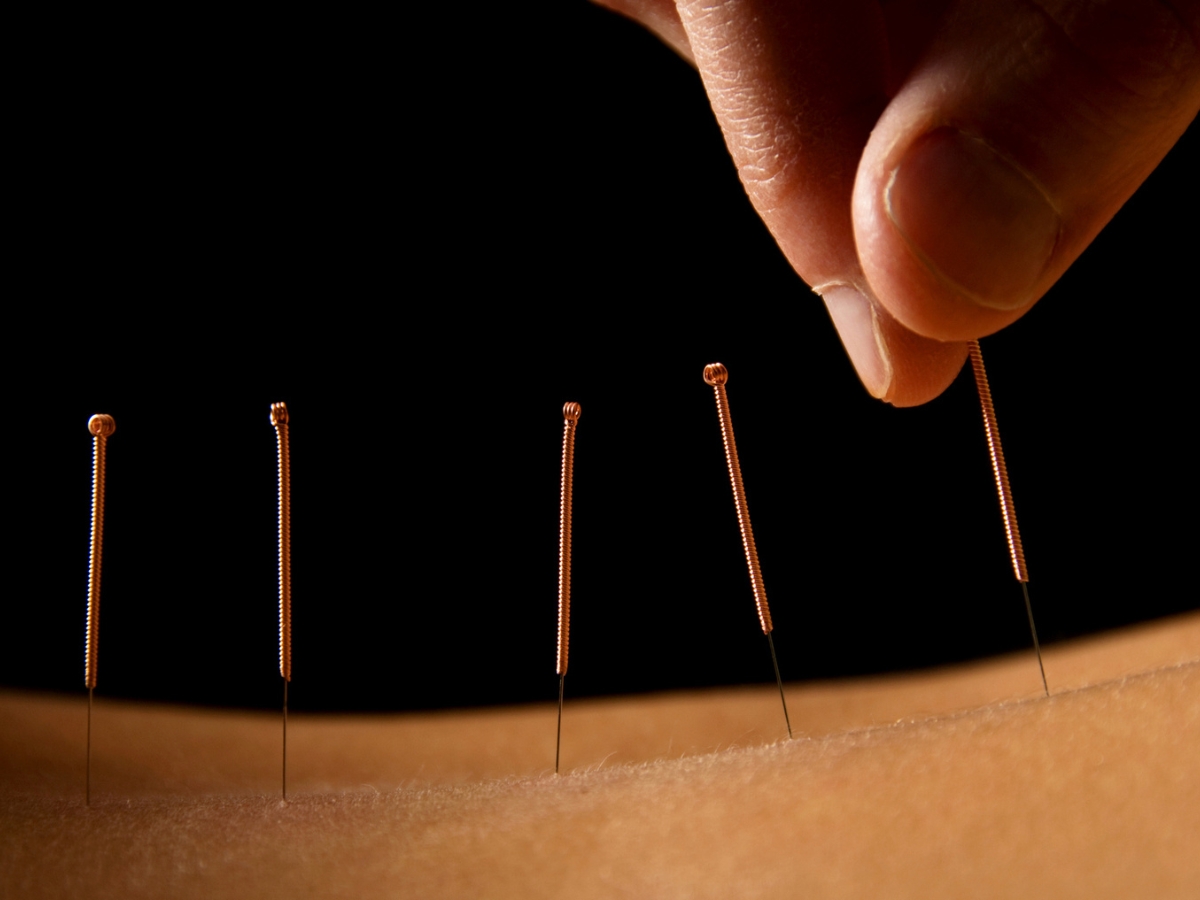 Services - Painless Acupuncture Clinic in Huntington Beach, California