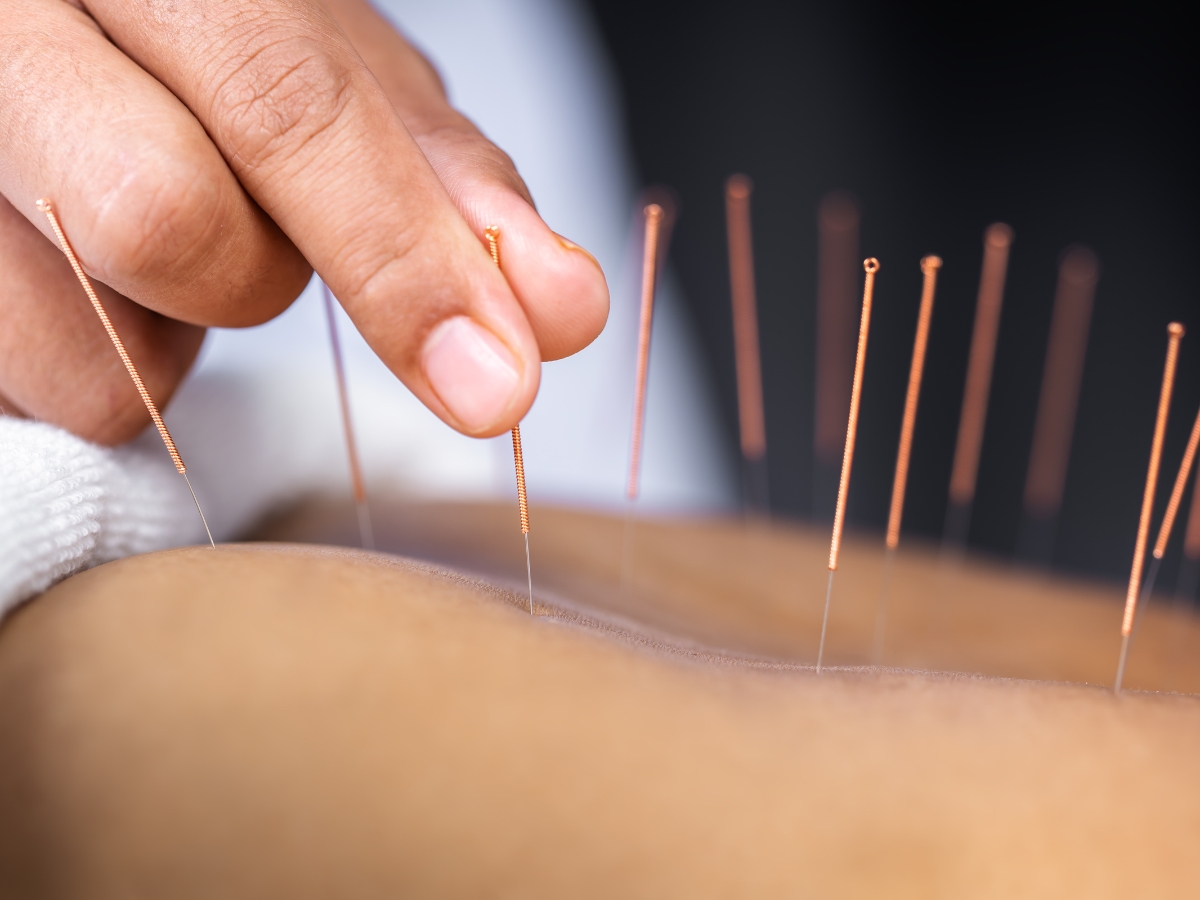 New Patients - Painless Acupuncture Clinic in Huntington Beach, California