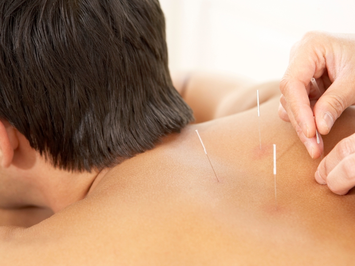 Acupuncture and the Nervous System: How It Blocks Pain Signals Naturally, Painless Acupuncture Clinic in Huntington Beach, California