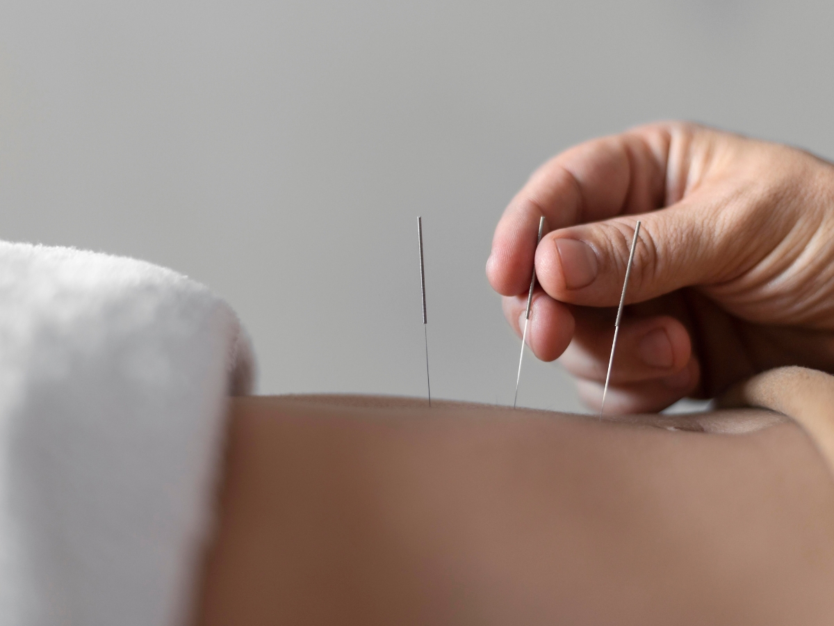 Painless Acupuncture Clinic in Huntington Beach, California