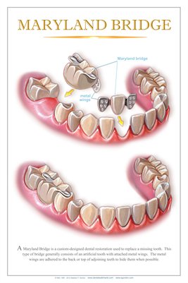 "MARYLAND BRIDGE" - (white) Dental Wall Chart DWC132